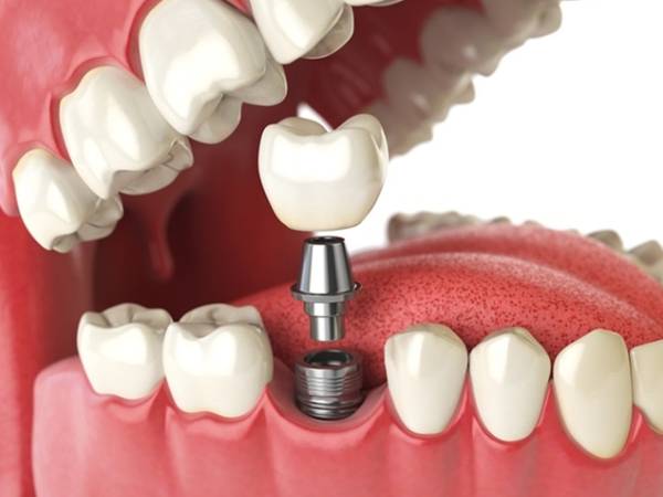 dental implants tab